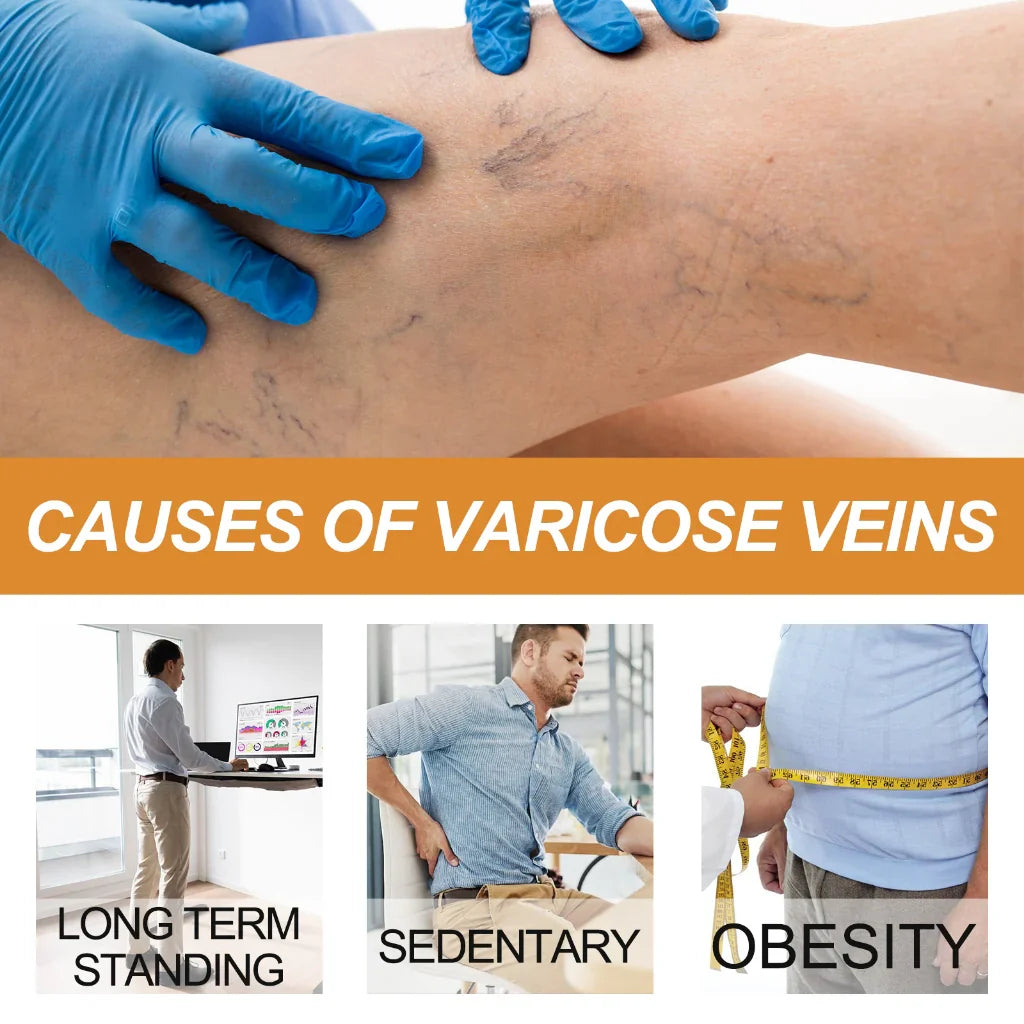 Vein Healing Varicose Veins Treatment Spray 50ml (Pack Of 2)