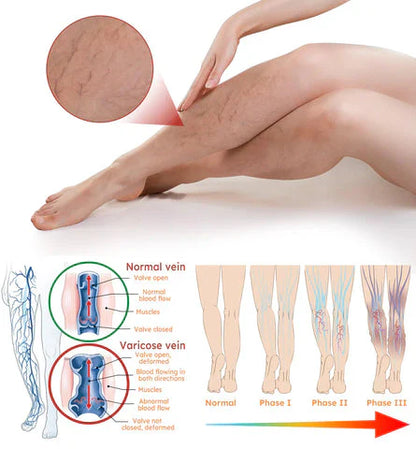 Vein Healing Varicose Veins Treatment Spray 50ml (Pack Of 2)